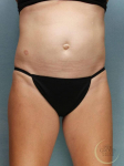 Coolsculpting Case 110 Before